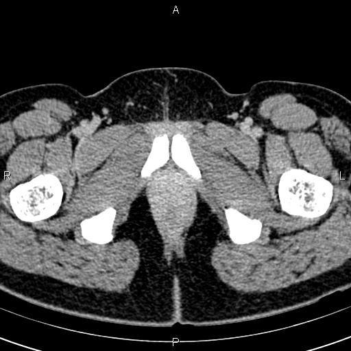 Bilateral ovarian teratoma (Radiopaedia 83131-97503 B 86).jpg