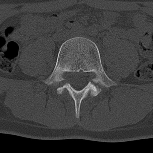 File:Bilateral pars defect (Radiopaedia 26691-26846 Axial bone window 31).jpg