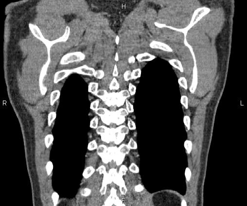 File:Bilateral pulmonary AVM (Radiopaedia 83134-97505 C 67).jpg