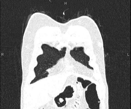 Bilateral pulmonary AVM (Radiopaedia 83134-97505 Coronal lung window 17).jpg