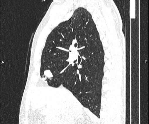 Bilateral pulmonary AVM (Radiopaedia 83134-97505 Sagittal lung window 49).jpg