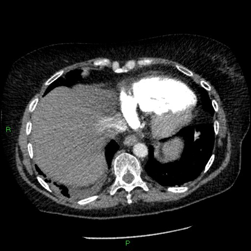 Bilateral pulmonary emboli (Radiopaedia 32700-33669 Axial C+ CTPA 88).jpg
