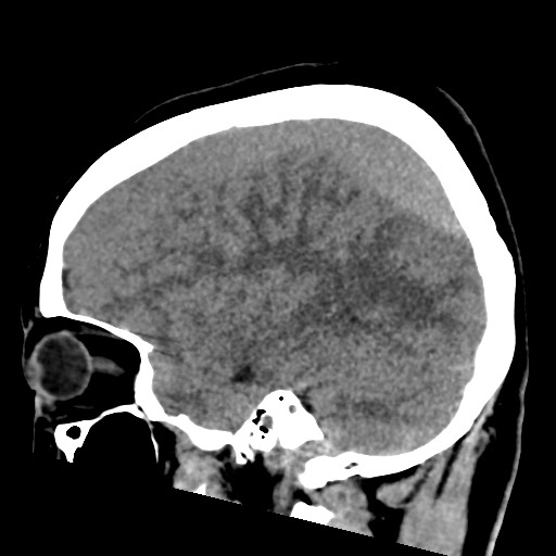 File:Bilateral subacute subdural hematoma (Radiopaedia 69240-79018 C 16).jpg