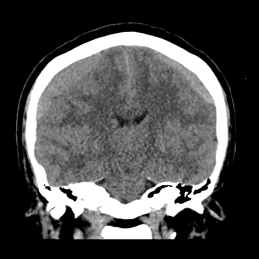 Bilateral subacute subdural hematoma (Radiopaedia 69240-79018 Coronal non-contrast 31).jpg