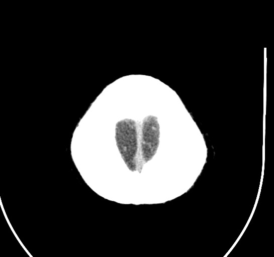 Bilateral subdural hygroma (Radiopaedia 73637-84421 Axial 2).jpg