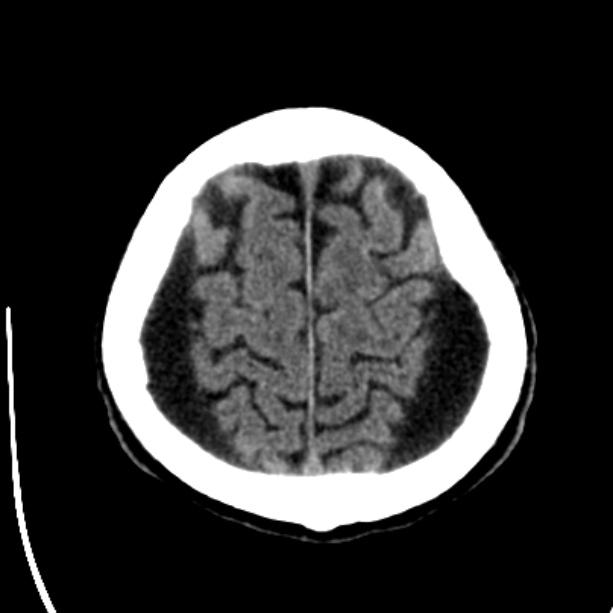 Bilateral subdural hygromata (Radiopaedia 29245-29656 Axial non-contrast 41).jpg