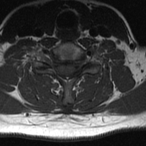 File:Bilateral tortuous vertebral arteries (Radiopaedia 19070-19039 Axial T2 1).jpg