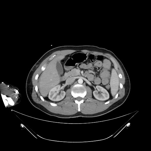 Bile leak from liver traumatic laceration (Radiopaedia 63463-72078 A 27).jpg