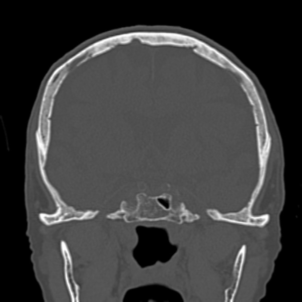 Biparietal osteodystrophy (Radiopaedia 46109-50463 Coronal bone window 49).jpg