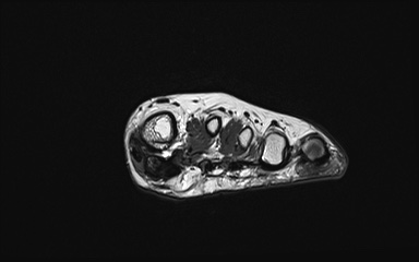 Bipartite hallux sesamoid diastasis (Radiopaedia 77133-89109 Coronal PD 25).jpg