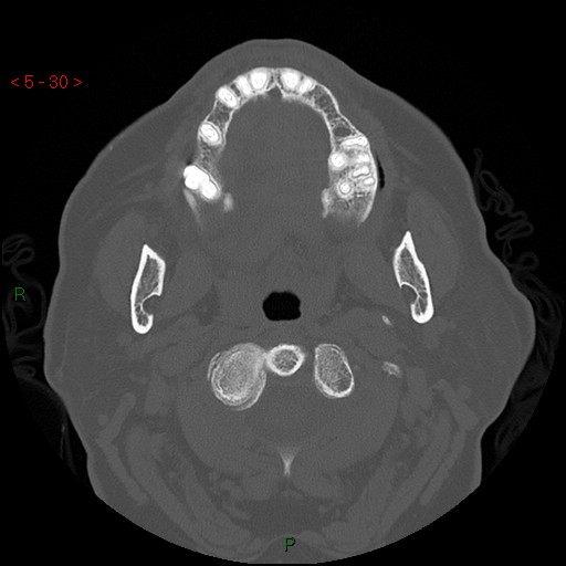 File:Bisphosphonate-related osteonecrosis of the jaw (Radiopaedia 54147-60329 Axial bone window 24).jpg
