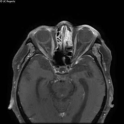 Bisphosphonate-related osteonecrosis of the maxilla (Radiopaedia 51367-57101 Axial T1 C+ fat sat 36).jpg