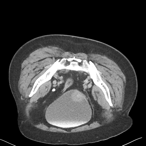 File:Bladder papillary urothelial carcinoma (Radiopaedia 48119-52951 Axial C+ delayed 47).png