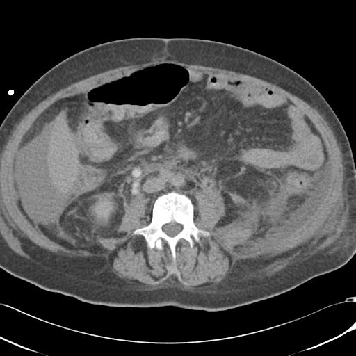 Bladder rupture post renal biopsy (Radiopaedia 30863-31572 Axial non-contrast 48).jpg