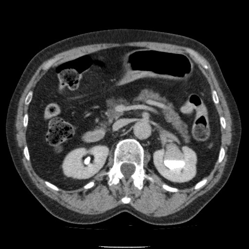 Bladder tumor detected on trauma CT (Radiopaedia 51809-57609 C 48).jpg