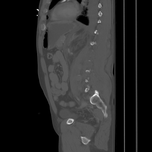 Blunt abdominal trauma with solid organ and musculoskelatal injury with active extravasation (Radiopaedia 68364-77895 Sagittal bone window 65).jpg