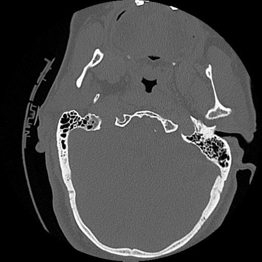 File:Blunt cerebrovascular injury (Radiopaedia 53682-59743 Axial bone window 9).png
