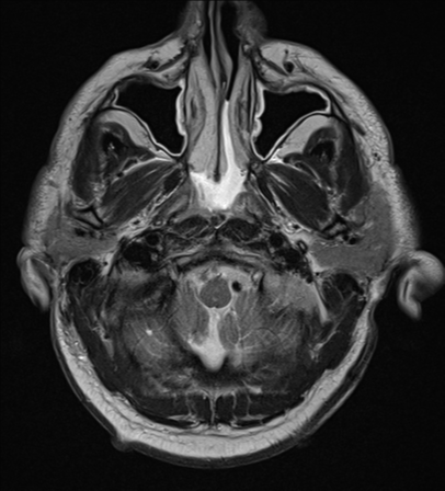 File:Blunt cerebrovascular injury (Radiopaedia 53682-59745 Axial T2 4).png