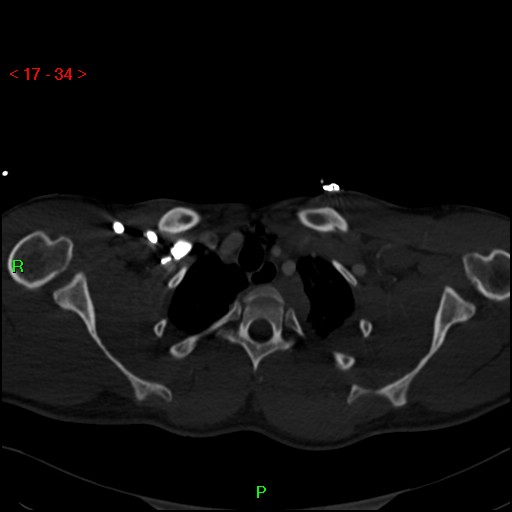 Blunt thoracic trauma (Radiopaedia 73454-84221 Axial bone window 14).jpg