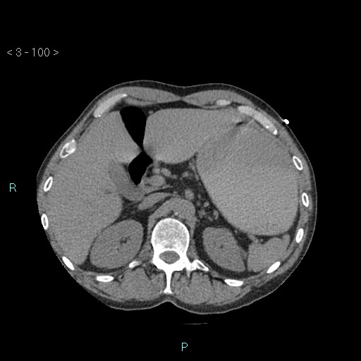Boerhaave syndrome (Radiopaedia 27683-27897 oral contrast 100).jpg