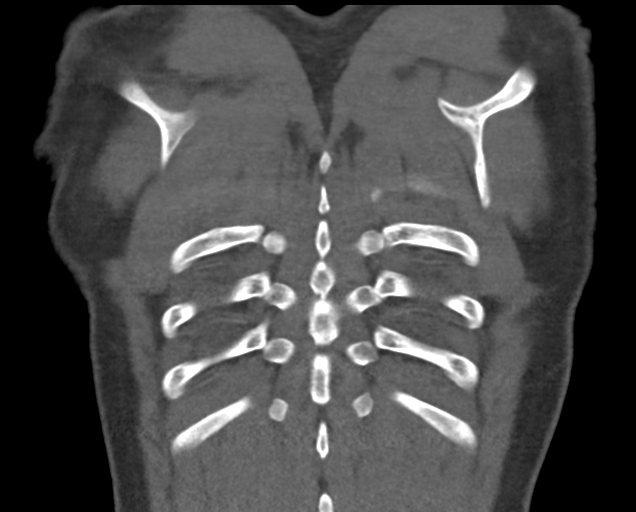 Boerhaave syndrome (Radiopaedia 39382-41660 C 82).png