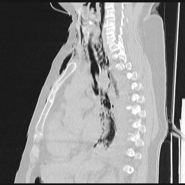 Boerhaave syndrome (Radiopaedia 45644-49799 Sagittal lung window 37).jpg