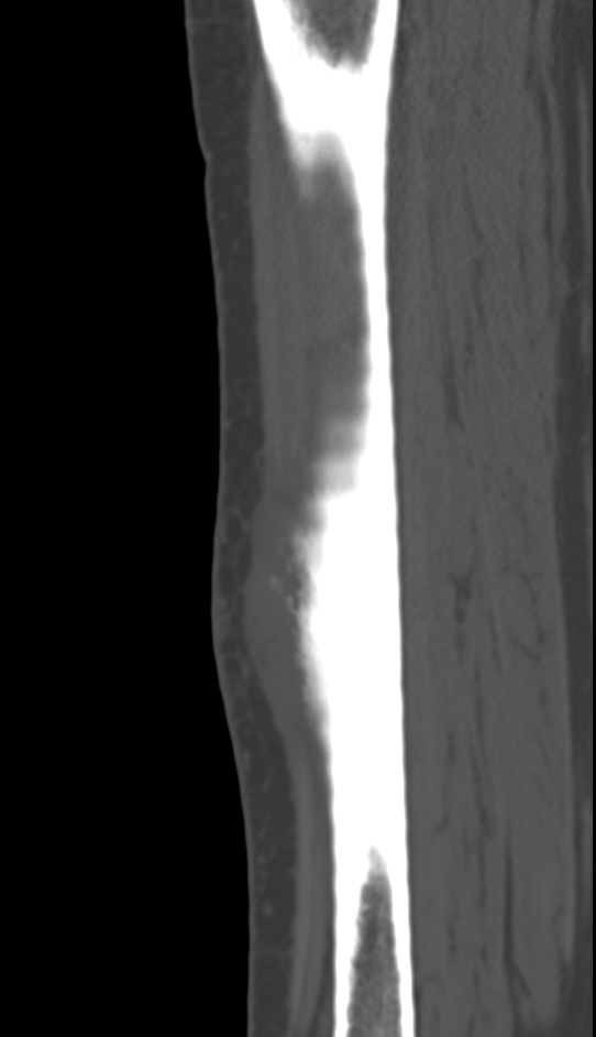 Bone metastasis - tibia (Radiopaedia 57665-64609 Sagittal bone window 108).jpg