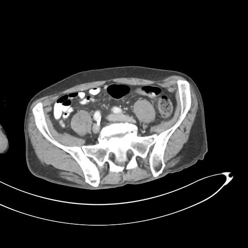 Bone metastasis from squamous cell carcinoma (Radiopaedia 30133-30730 B 53).jpg