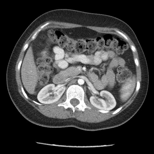 File:Borderline mucinous tumor (ovary) (Radiopaedia 78228-90808 A 54).jpg
