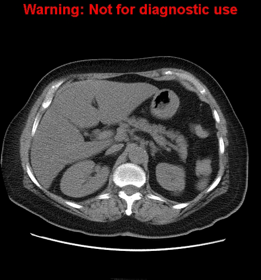 File:Bosniak renal cyst - type II (Radiopaedia 23404-23468 Axial non-contrast 6).jpg