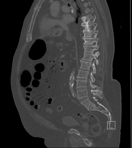 Bowel ischemia secondary to SMA occlusion with extensive portomesenteric venous gas (Radiopaedia 54656-60871 Sagittal bone window 54).jpg
