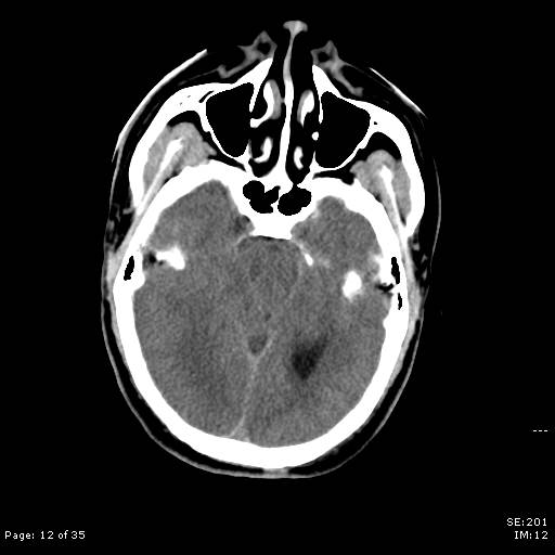 File:Brain death after motor vehicle collision (Radiopaedia 88470-105114 Axial non-contrast 12).jpg