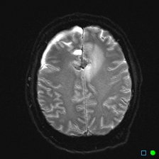 File:Brain death on MRI and CT angiography (Radiopaedia 42560-45689 Axial ADC 23).jpg