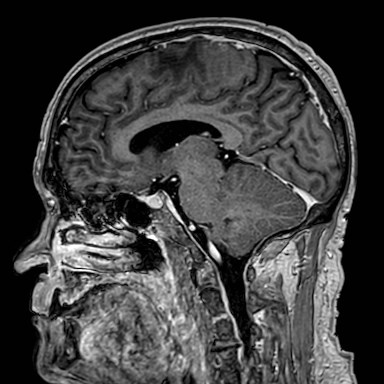 Brain metastases from lung cancer (Radiopaedia 83839-99028 Sagittal T1 C+ 35).jpg