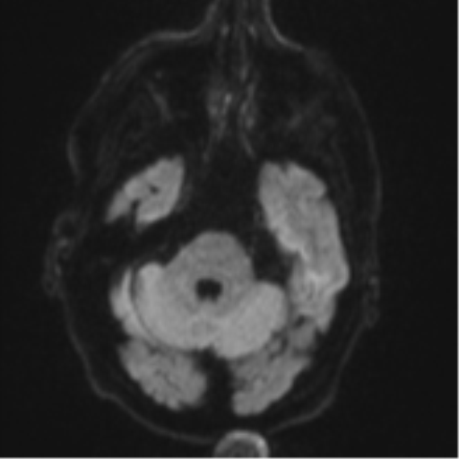 File:Brain metastasis (lung cancer) (Radiopaedia 48289-53179 Axial DWI 35).png