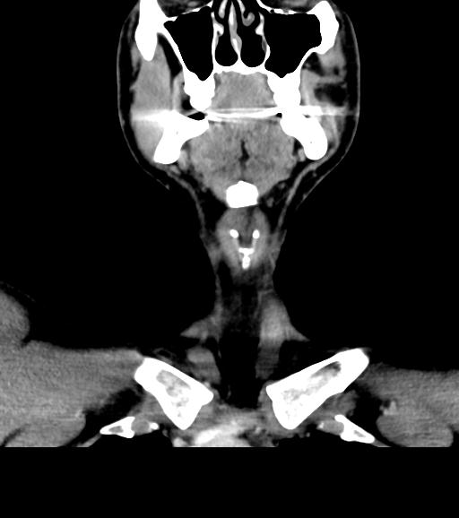 Branchial cleft cyst (Radiopaedia 31167-31875 Coronal C+ delayed 21).jpg