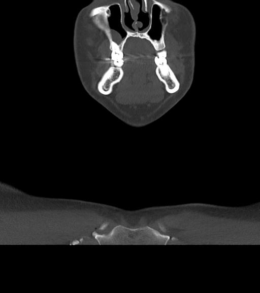 File:Branchial cleft cyst (Radiopaedia 31167-31875 Coronal bone window 16).jpg