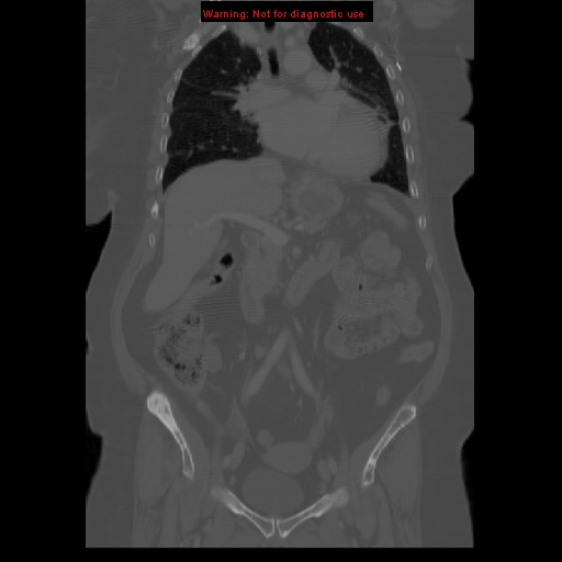 File:Breast cancer metastasis (Radiopaedia 10001-10554 B 29).jpg