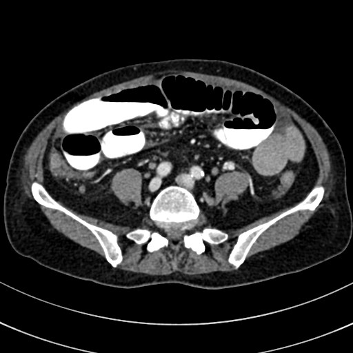 File:Broad ligament hernia (Radiopaedia 84802-100276 A 73).jpg