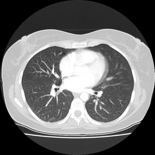 Bronchial atresia (Radiopaedia 22965-22992 Axial lung window 24).jpg