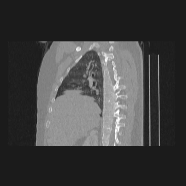 Bronchial atresia (Radiopaedia 60685-68439 Sagittal lung window 30).jpg