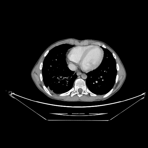 Bronchial carcinoid tumor (Radiopaedia 57187-64090 A 57).jpg