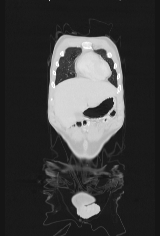 Bronchial carcinoid tumor (Radiopaedia 57187-64090 Coronal lung window 8).jpg