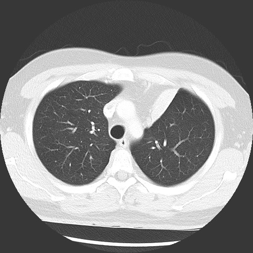 Bronchial carcinoid tumor (Radiopaedia 67377-76764 Axial lung window 20).jpg