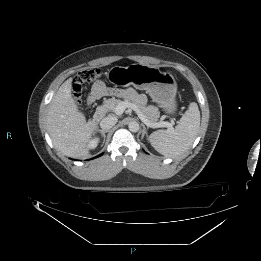 Bronchial carcinoid tumor (Radiopaedia 78272-90870 C 128).jpg