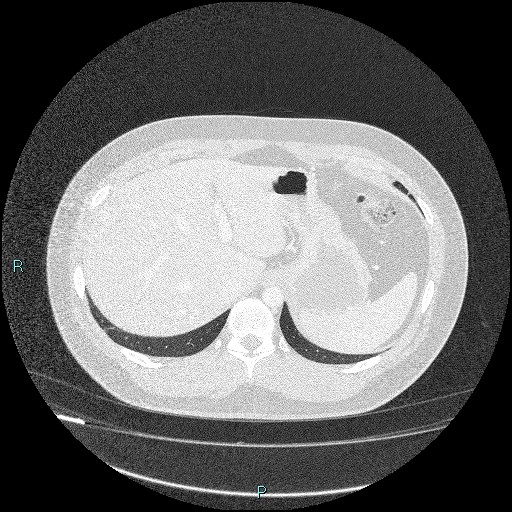 Bronchial carcinoid tumor (Radiopaedia 78272-90875 Axial lung window 50).jpg