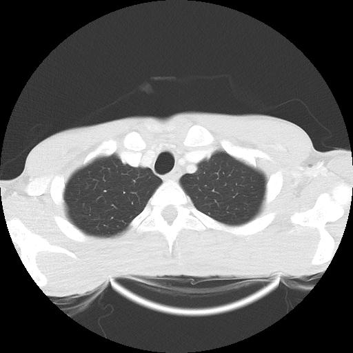 Bronchial carcinoid tumor causing right lower lobe collapse (Radiopaedia 83495-98594 Axial lung window 4).jpg