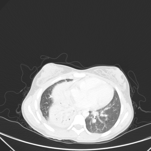 Bronchial mucoepidermoid carcinoma (Radiopaedia 57023-63895 Axial lung window 69).jpg
