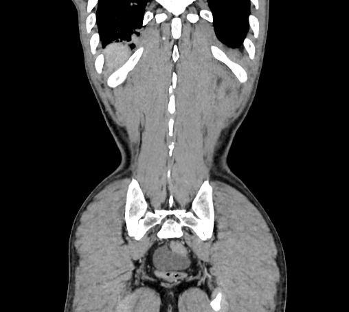 File:Bronchiectasis in Crohn disease (Radiopaedia 60311-67977 C 78).jpg