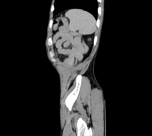 File:Bronchiectasis in Crohn disease (Radiopaedia 60311-67977 D 107).jpg